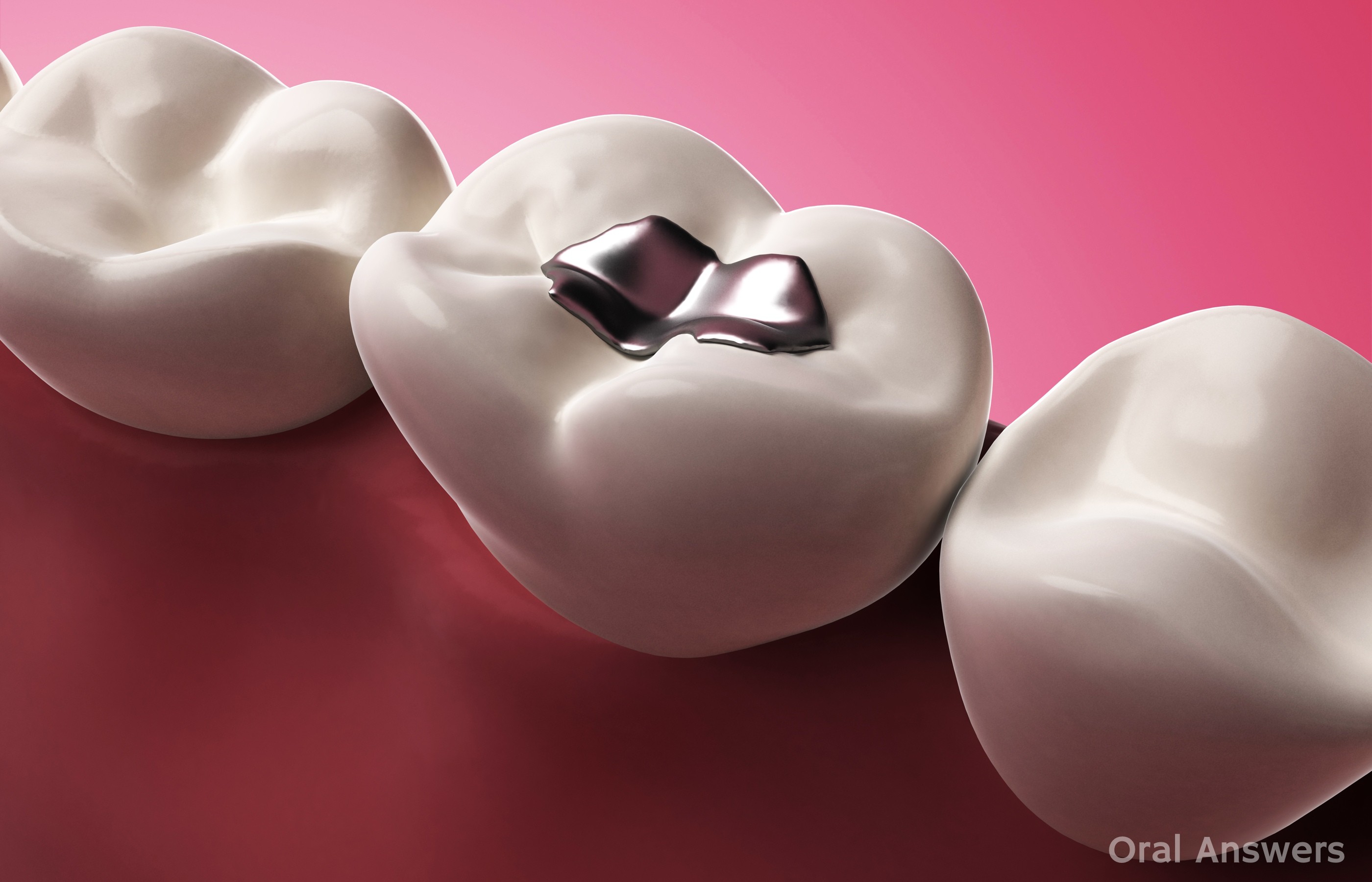 graphic rendering of a row of teeth; one has a dental amalgam filling graphic rendering of a row of teeth; one has a dental amalgam filling